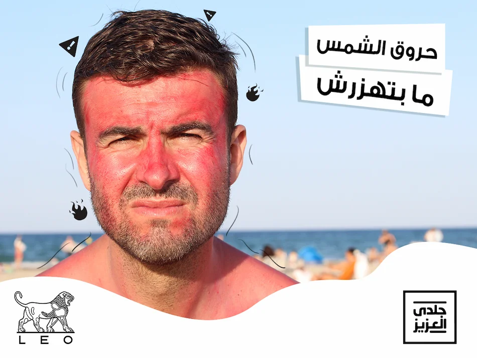 sunburn LEOGeldyElaziz